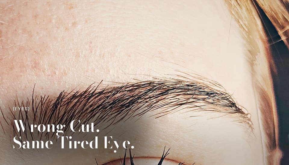 Heavy Lids Are Not Always Skin